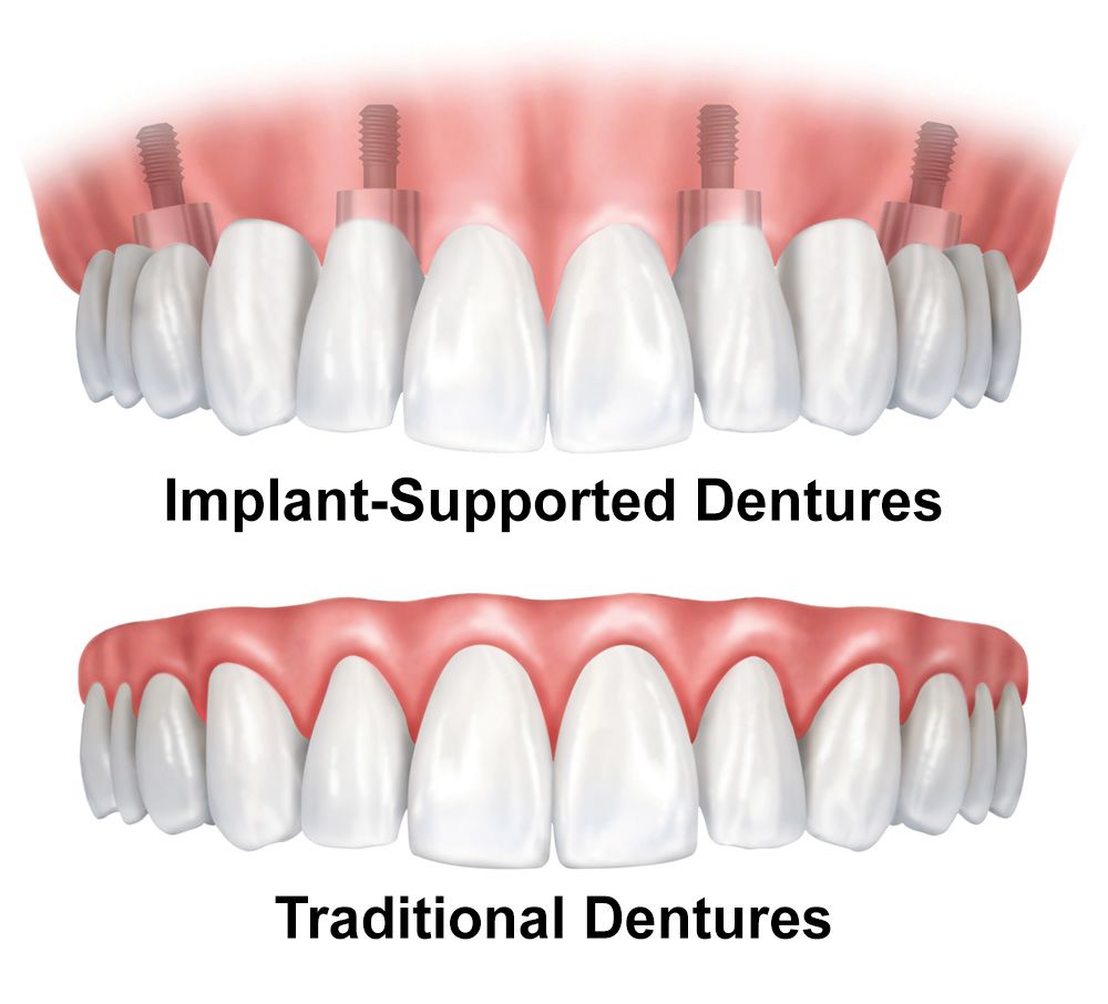 Illustration comparing implant-supported dentures to traditional dentures