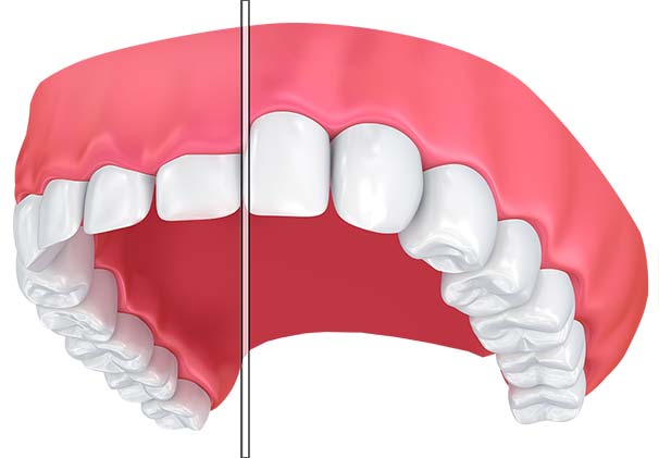A before and after photo showing how gum contouring can improve a gummy smile