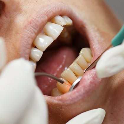A man undergoing laser dentistry treatment