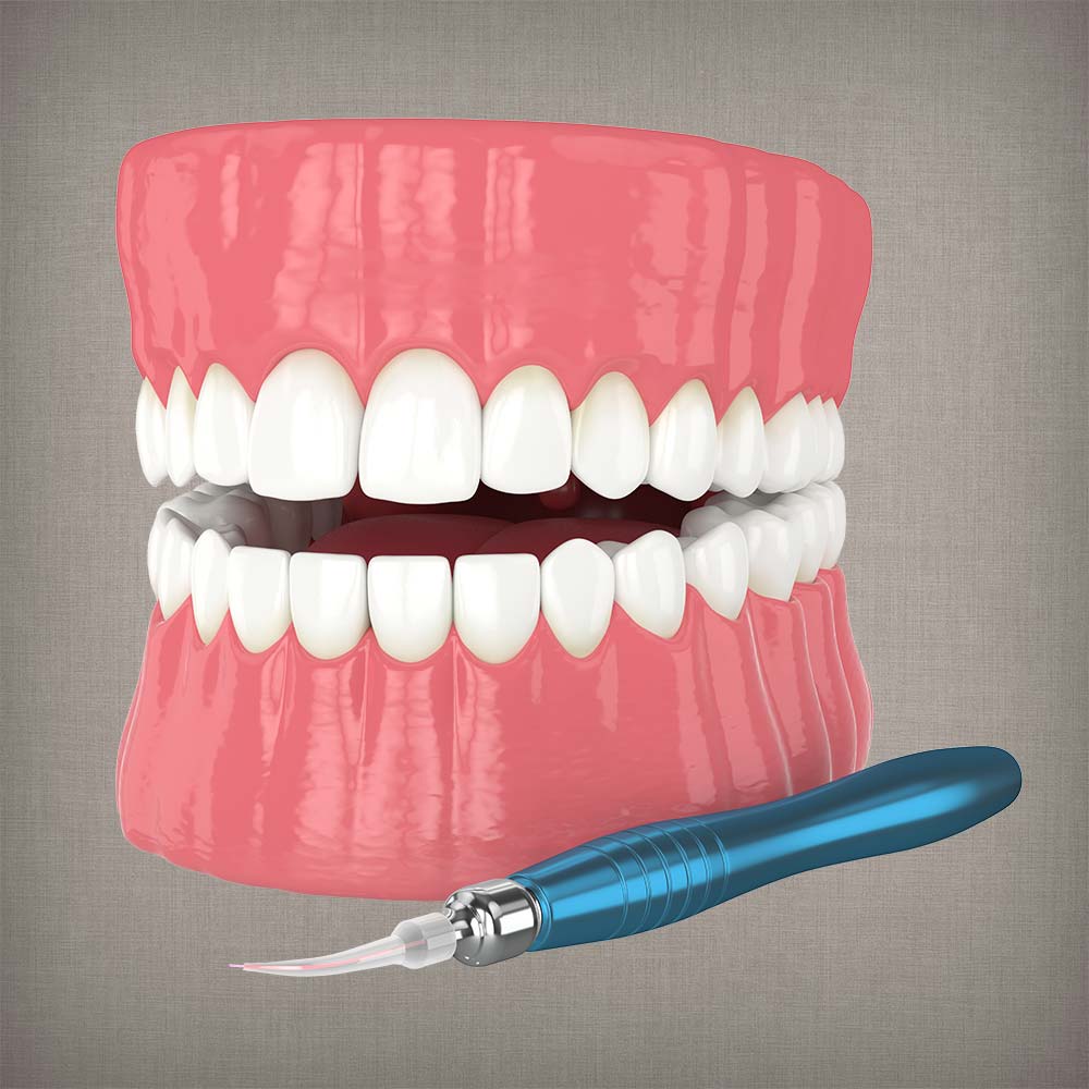 An illustration of a model of the teeth and a dental laser