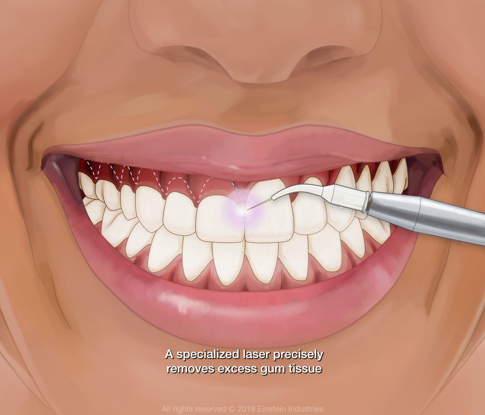 An illustration that shows how laser gum contouring works