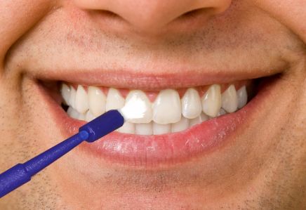 Fluoride application