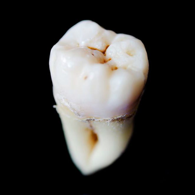 Close-up of tooth extracted during general dentistry procedure
